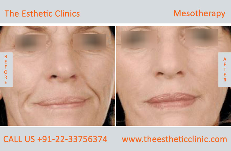 Mesotherapy for Hair Loss Face Skin Treatment before after photos in mumbai india (3)